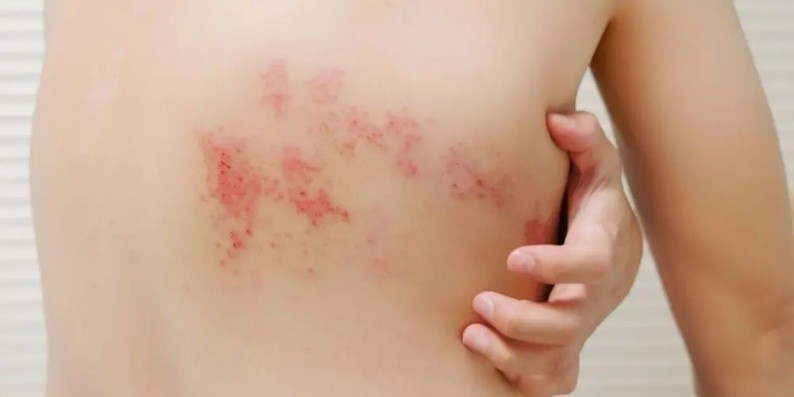 herpes zoster v ledvenem delu