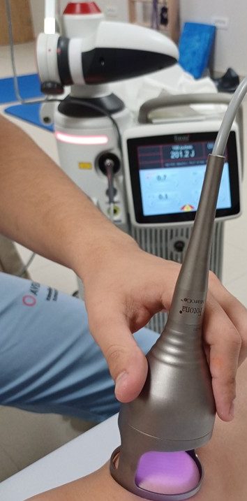 Lasersko zdravljenje Bellove pareze pareze obraznega živca