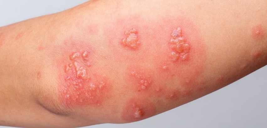 Lasersko zdravljenje pasovca (herpes zoster) | Avelana fizioterapija